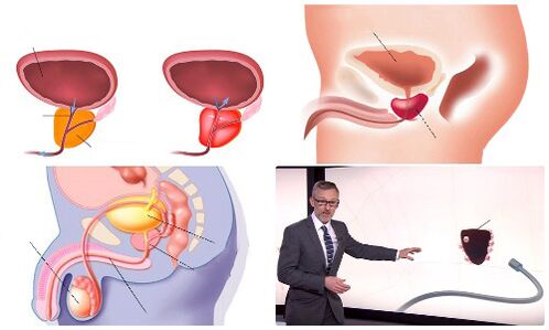 prostata sana e malata