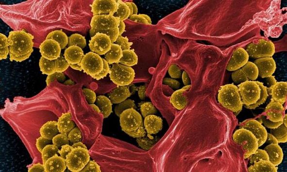 Staphylococcus aureus come causa di prostatite batterica