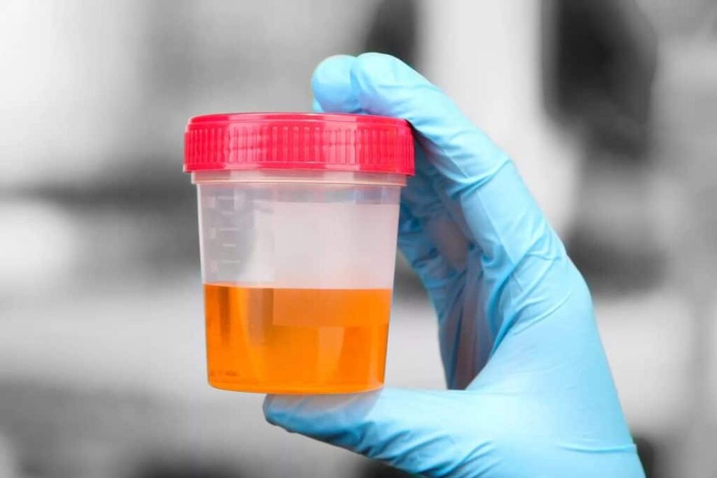 urina con sangue nella prostatite calcolosa